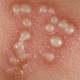 Illustration for article titled Obat Herpes